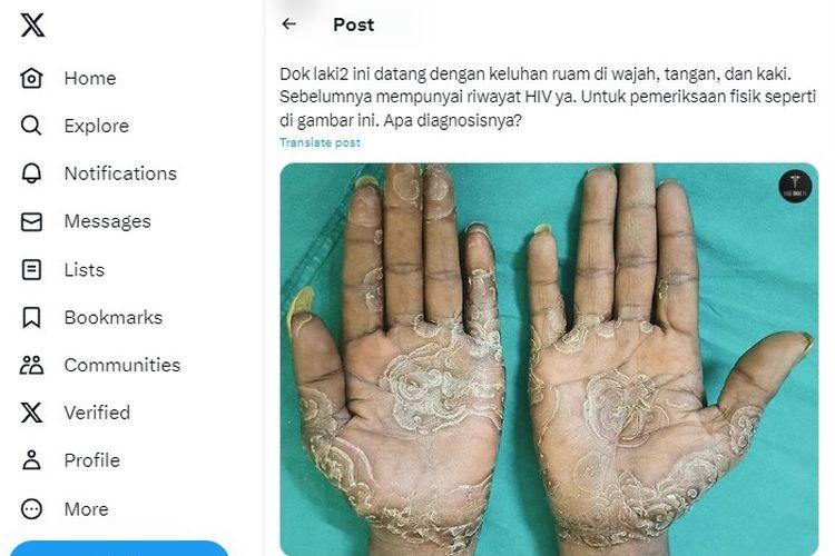 Apakah Ruam di Telapak Tangan Menunjukkan Gejala Sifilis?